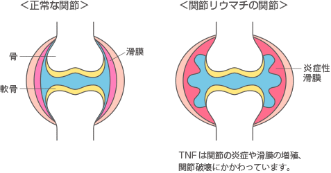 正常な関節と関節リウマチの関節　TNFは関節の炎症や滑膜の増殖、関節破壊に関わっています。